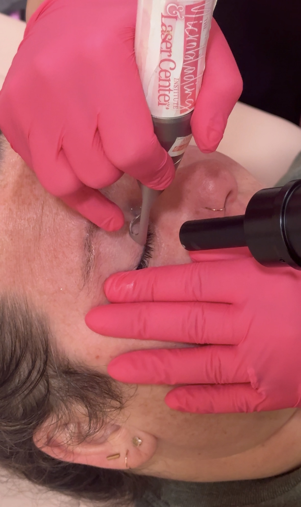 Laser Eyeliner Removal in Lafayette, Louisiana