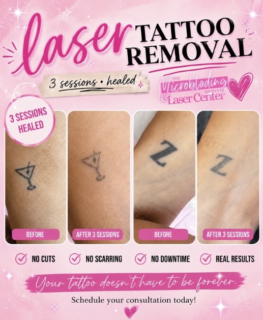 Healed laser tattoo removal progress after three sessions