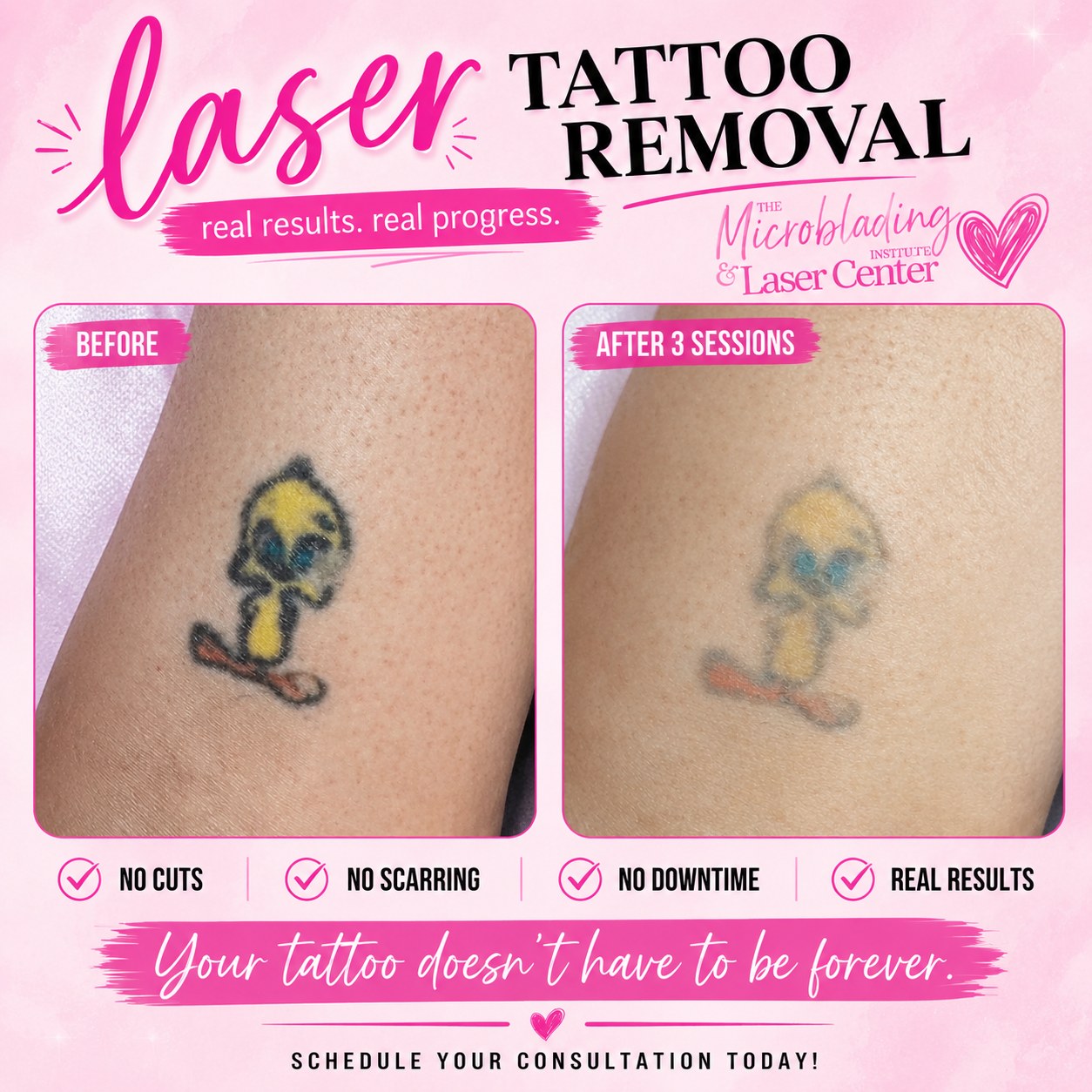 Before and after three sessions of laser tattoo removal
